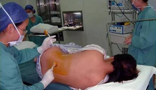 苹果新加坡版是中国产的吗:剖腹产手术的过程是怎样的，孕妈妈你知道吗？